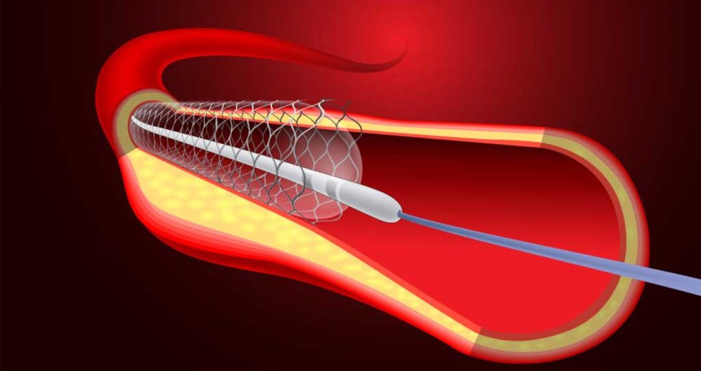 Stent Sonrası Yaşam