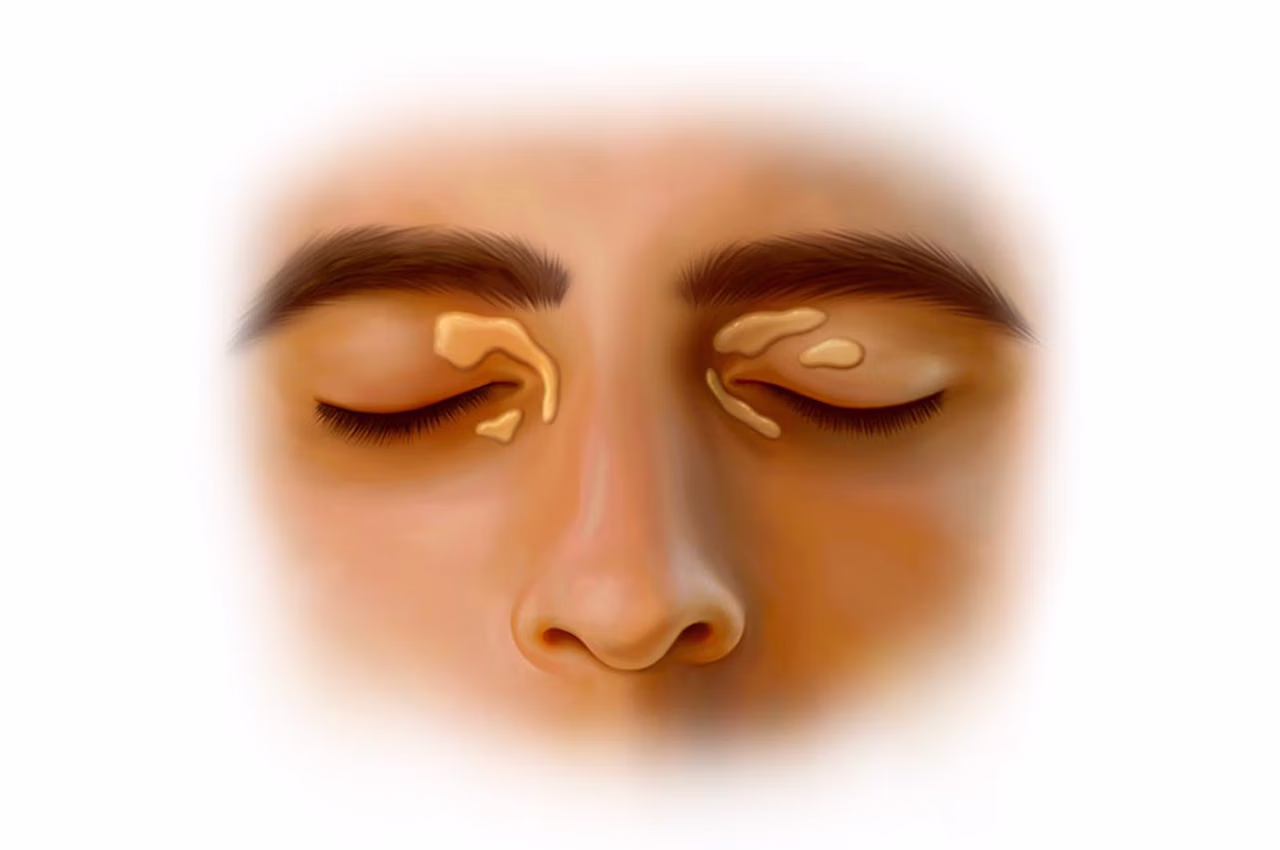 göz çevresindeki sarı lekeler