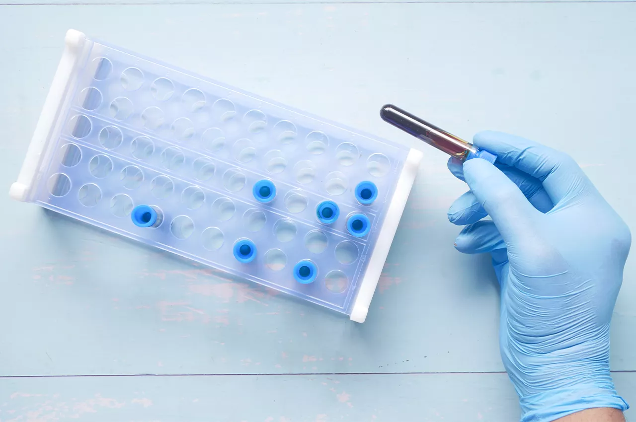 trigliserit seviyesi