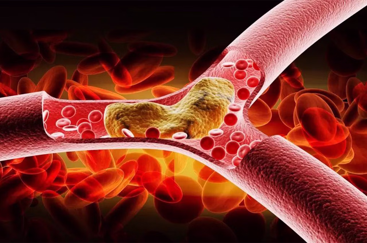 plak nasıl engellenir