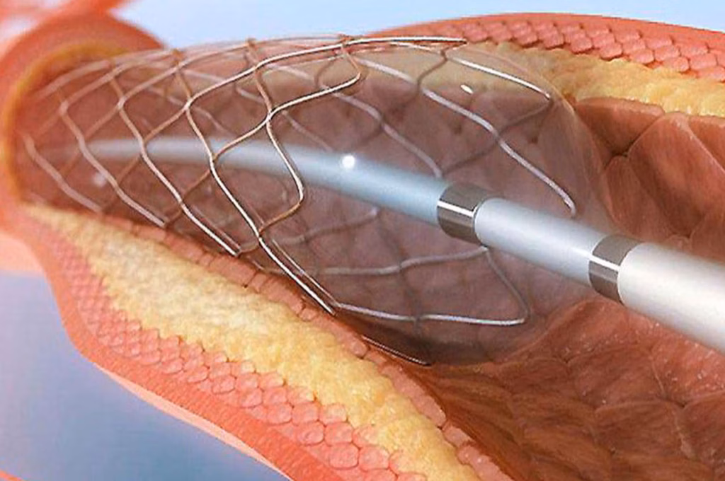 şah damar tıkanıklığı