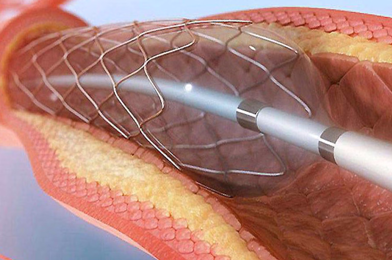 şah damar tıkanıklığı