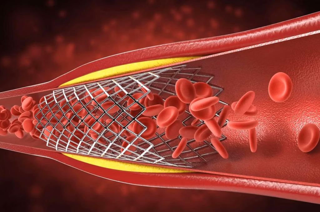 stentler tıkanır mı