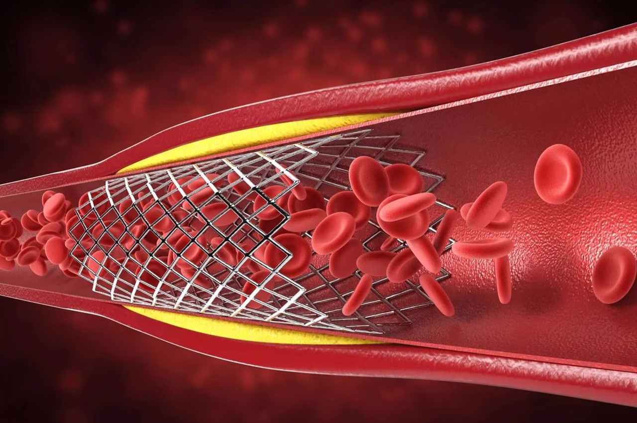 stentler tıkanır mı