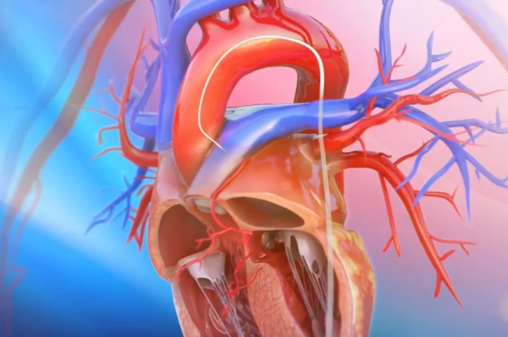 Alkol Septal Ablasyonu