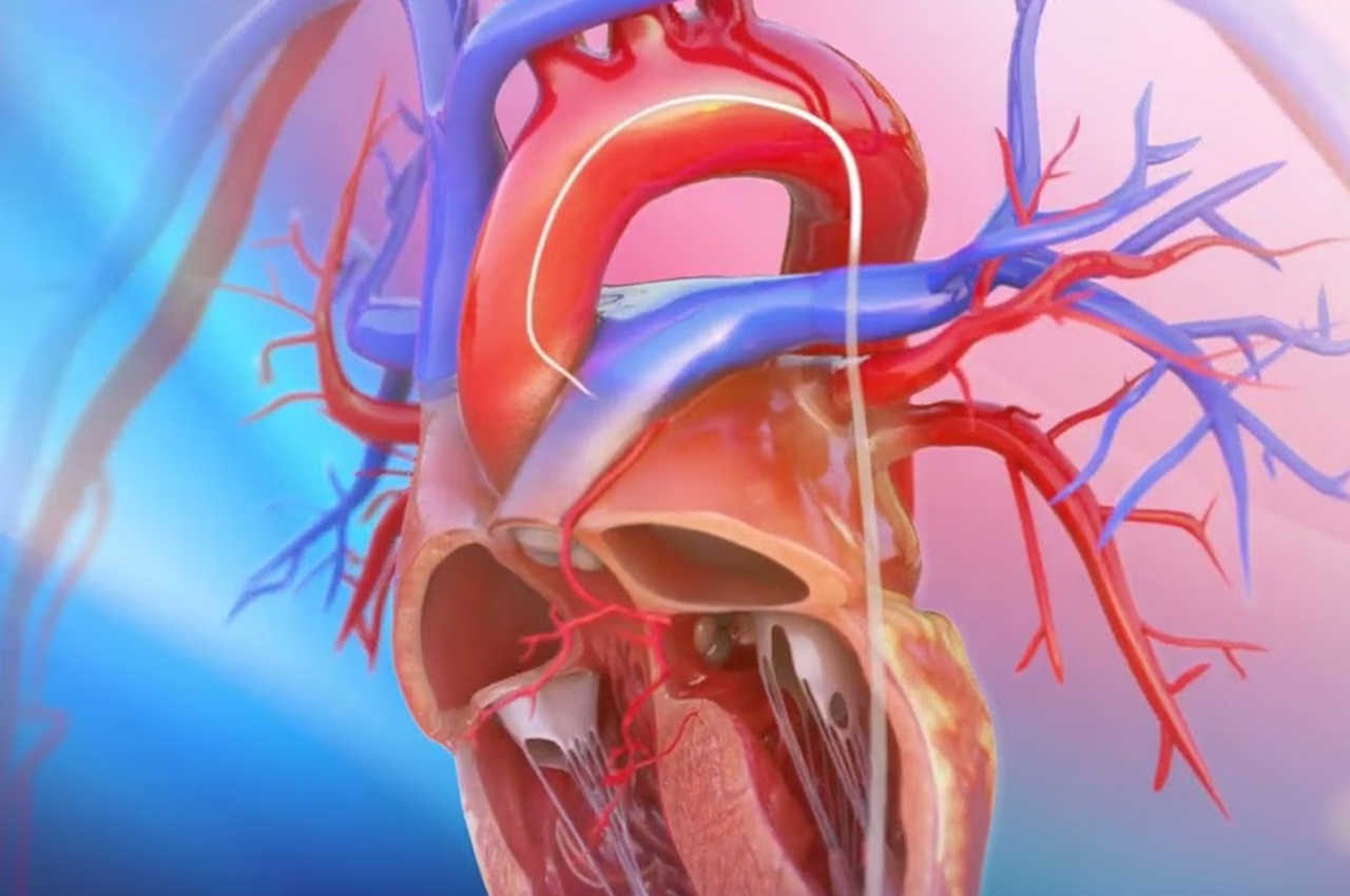 Alkol Septal Ablasyonu