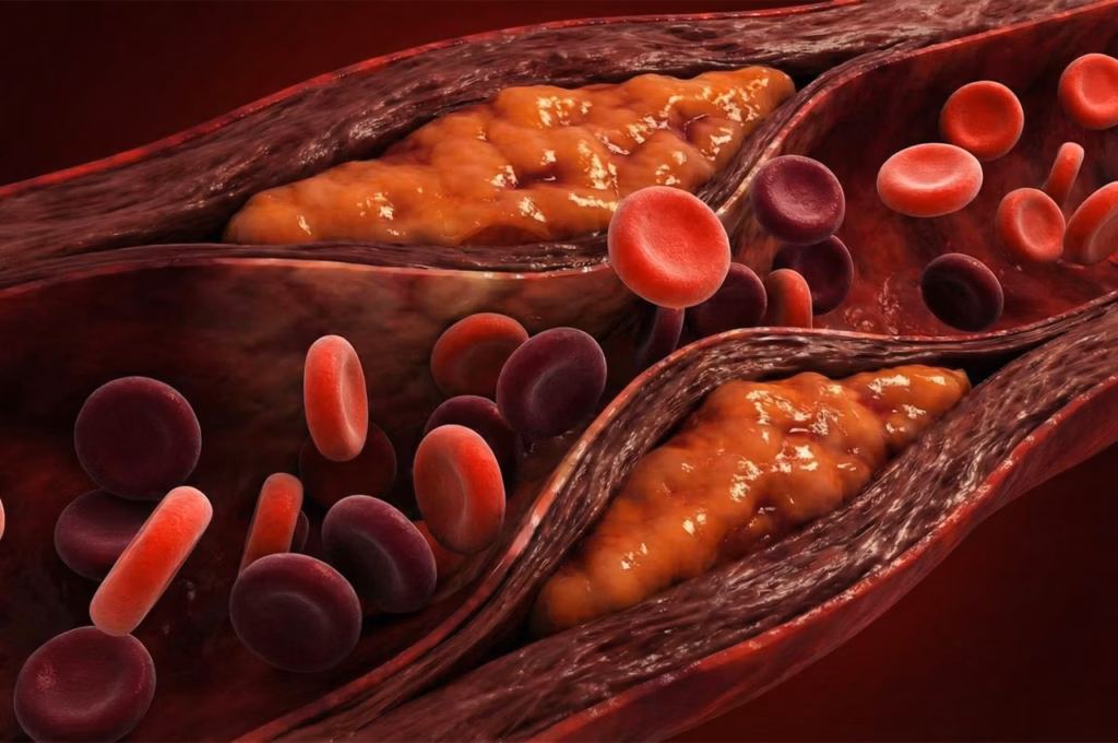 Ameliyatsız Bacak Damar Tıkanıklığı Tedavisi