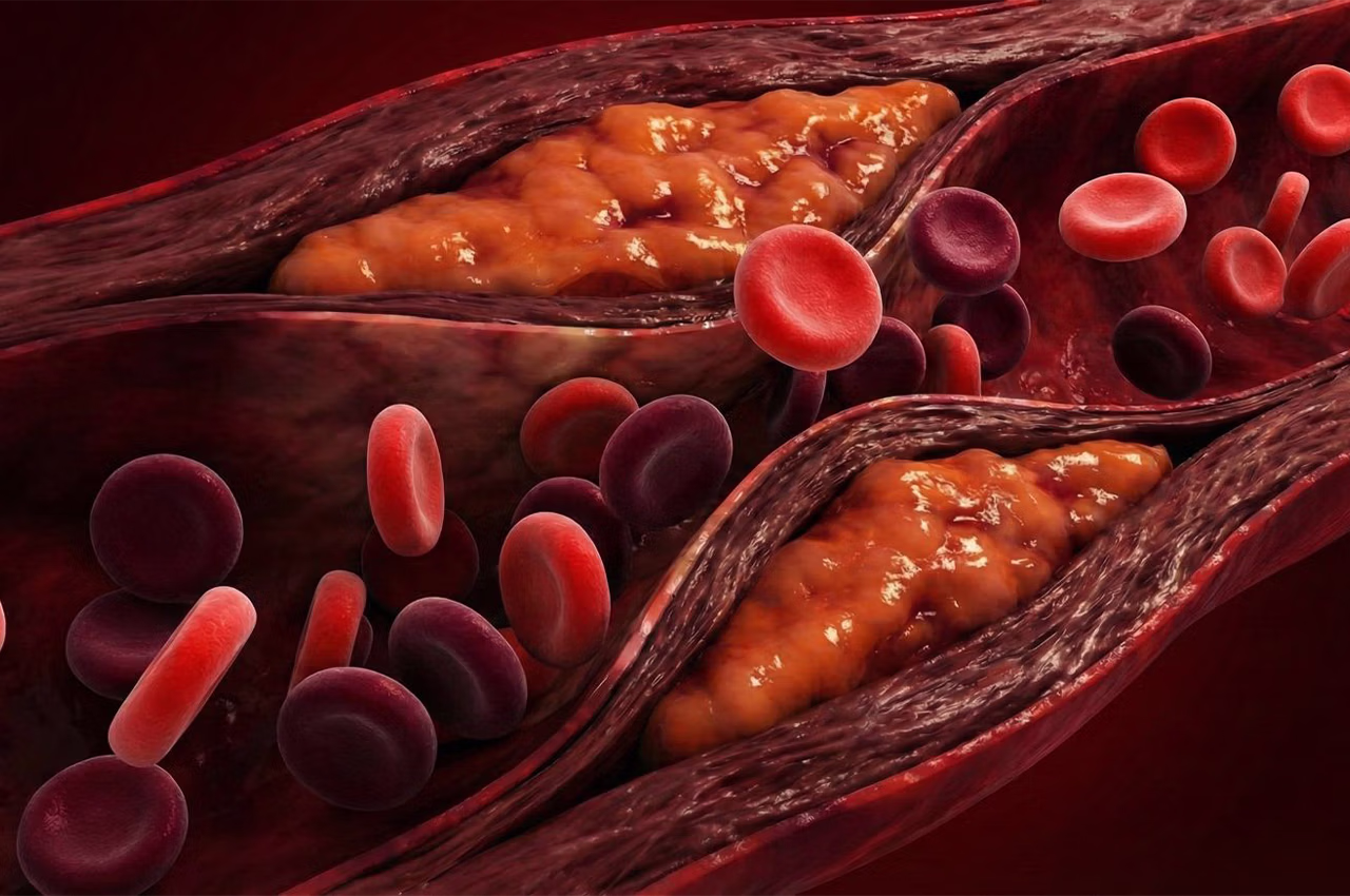 Ameliyatsız Bacak Damar Tıkanıklığı Tedavisi