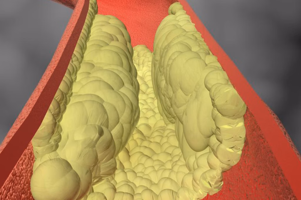 Kireçlenmiş Damarların Açılması