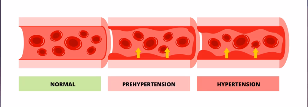 Tansiyon Nasıl Oluşmaktadır