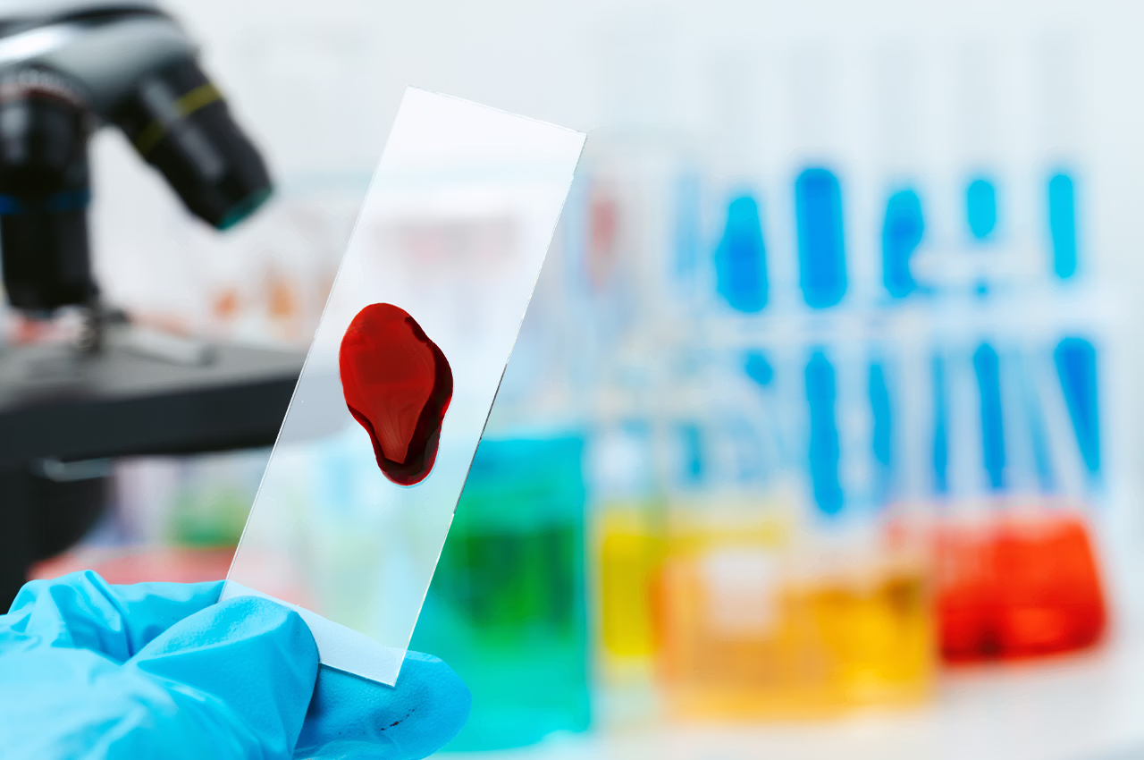 Antifosfolipid Sendromu