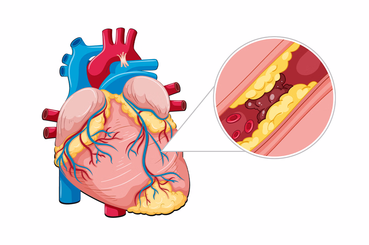 Büyük Arter Tıkanıklıkları