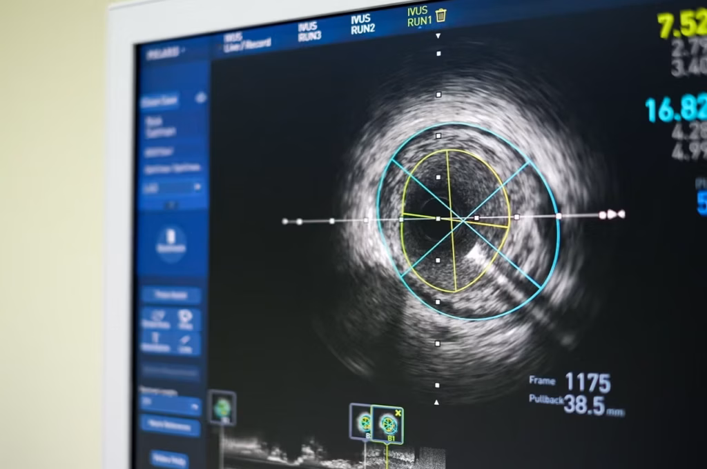 IVUS damar içi görüntüleme