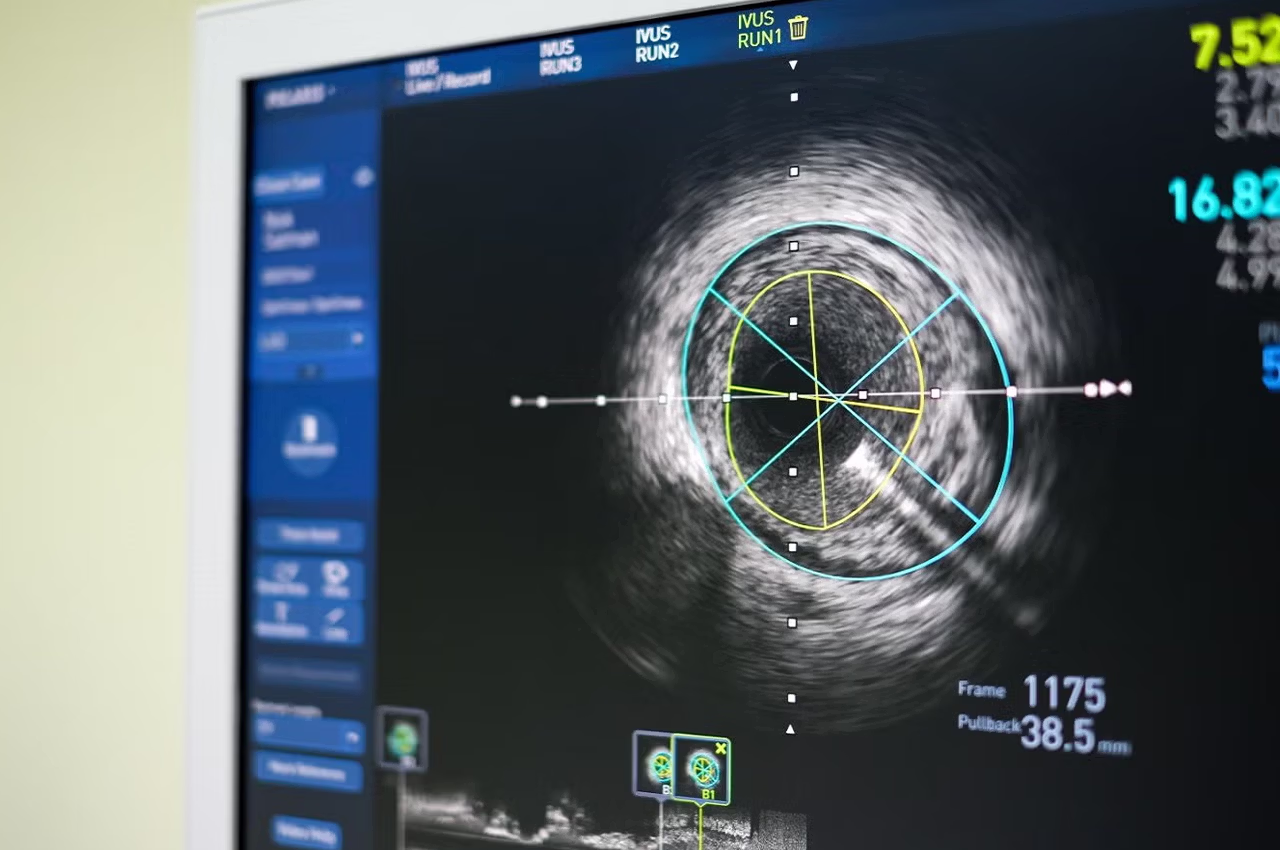 IVUS damar içi görüntüleme