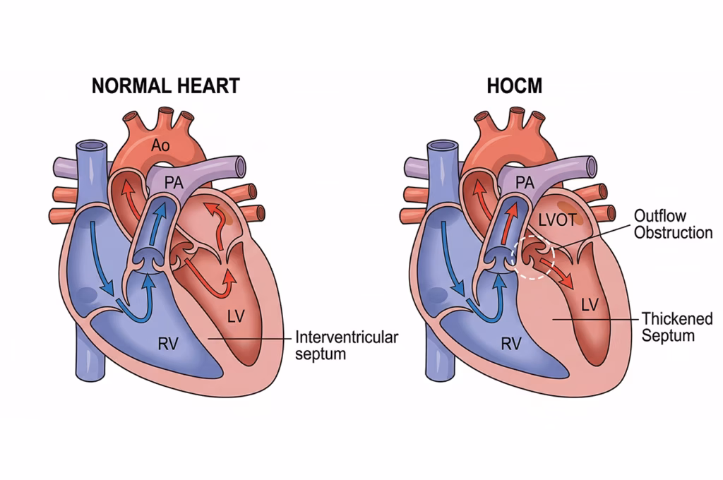 Septal Miyektomi