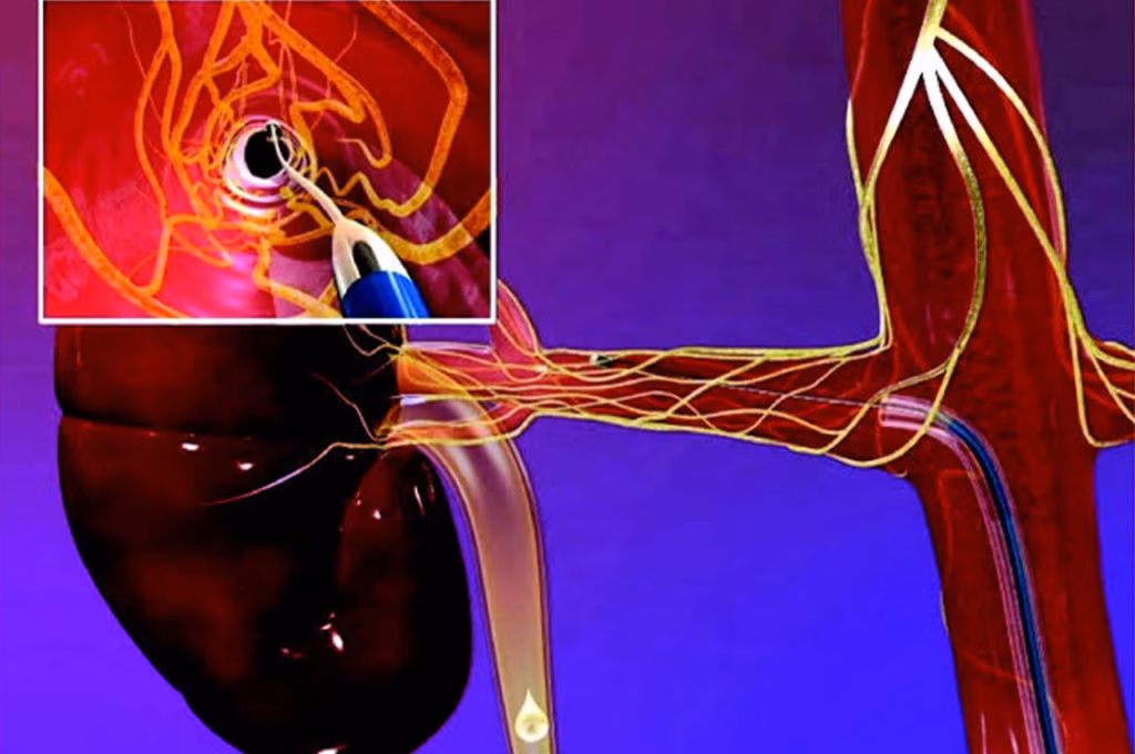 Renal Denervasyon
