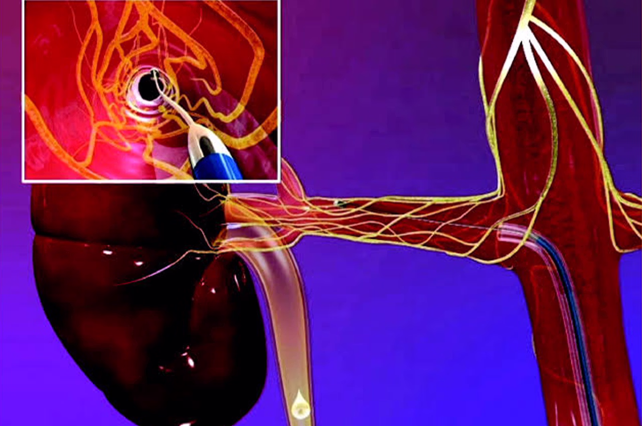 Renal Denervasyon