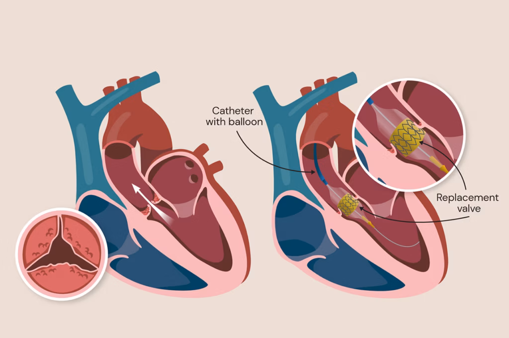 TAVİ Nedir