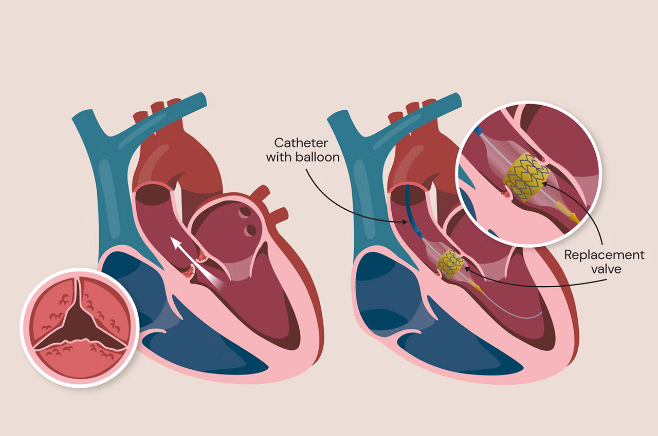 TAVİ Nedir