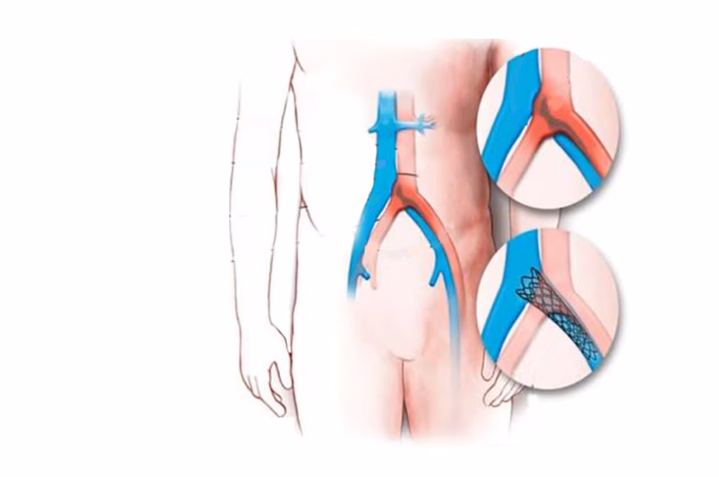 Vena Kavaya Filtre Stent Yerleştirilmesi