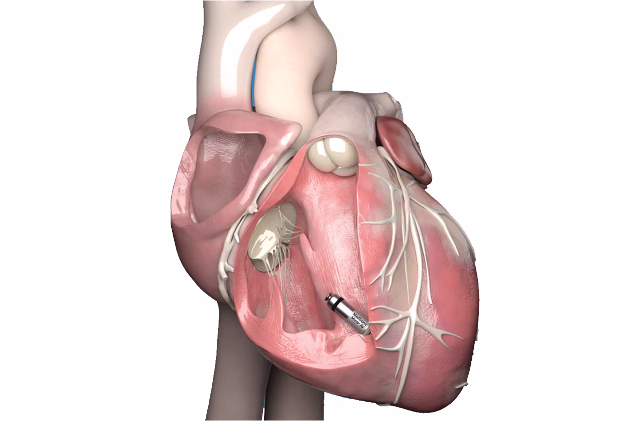 Kablosuz Kalp Pili (Pacemaker)