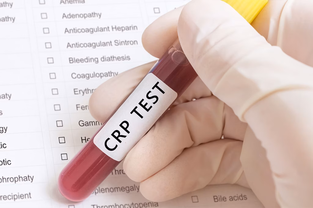 CRP ve hs-CRP kan tahlili sonucunun kalp damar sağlığıyla ilişkisi
