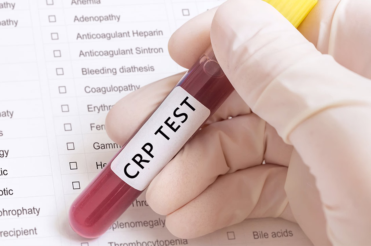 CRP ve hs-CRP kan tahlili sonucunun kalp damar sağlığıyla ilişkisi